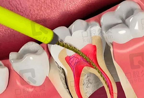 根管治疗的具体流程是什么