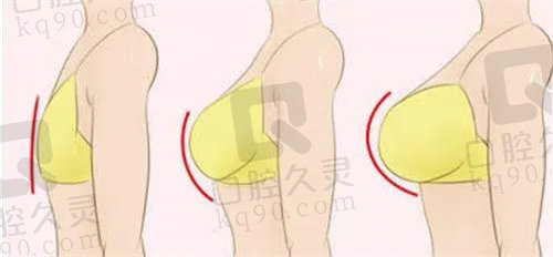 成都畫美趙敬國醫(yī)生Real復(fù)合隆胸價格
