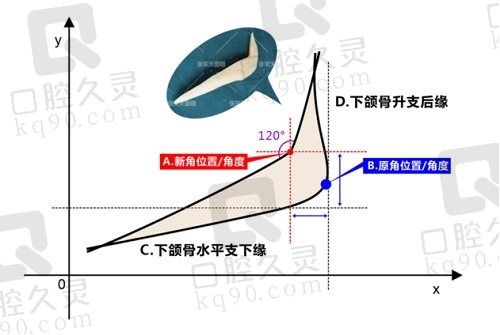 北京圣嘉新张笑天医生下颌角磨骨术