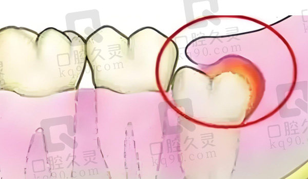 注意避免智齿发炎