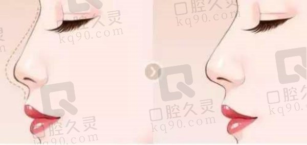 大连沙医生整形做鼻子怎么样