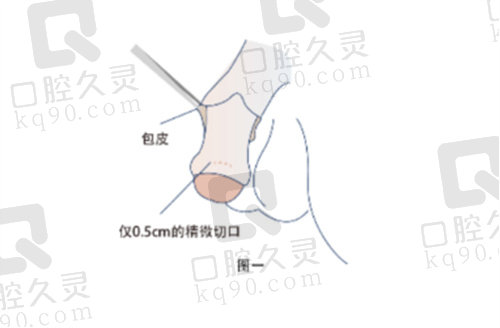 重庆星荣李世荣医生隐痕阴茎延长术优势