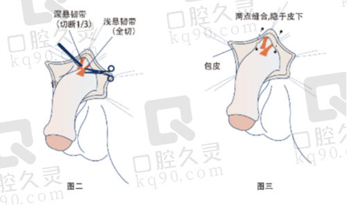 重庆星荣李世荣医生隐痕阴茎延长术优势