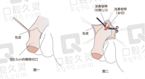 重庆星荣李世荣医生隐痕阴茎延长增粗术优势