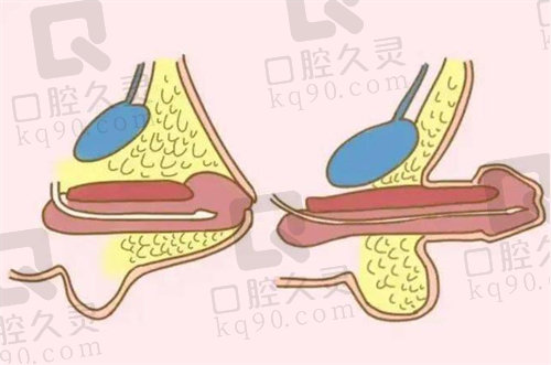 重庆星荣李世荣医生隐痕阴茎延长术价格