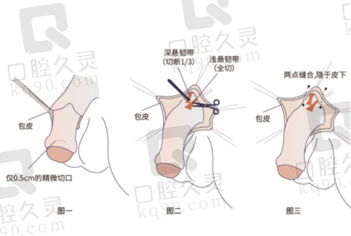 重庆星荣李世荣医生隐痕阴茎延长术优势