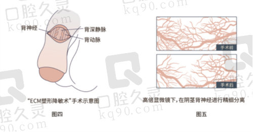 重庆星荣李世荣医生隐痕阴茎延长术优势