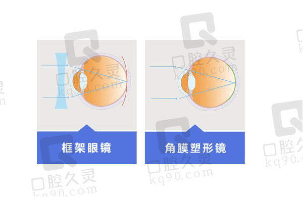 框架眼镜和角膜塑形镜哪个好？从价格方面比比看