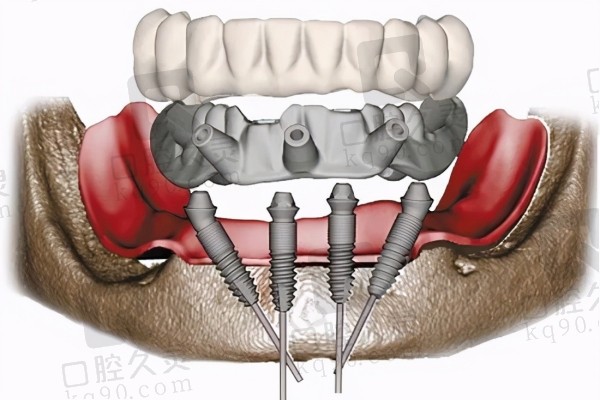 东莞牙状 元口腔医院半口种植牙技术怎么样？