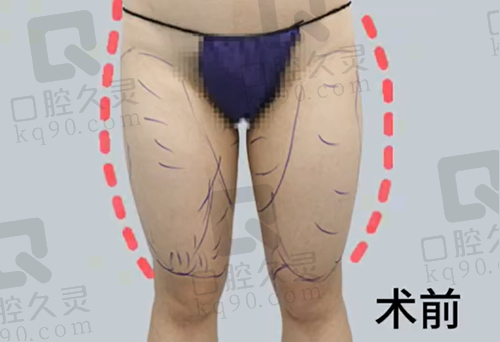 冯斌医生大腿吸脂术前