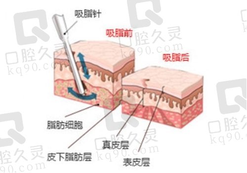 冯斌医生大腿吸脂手术