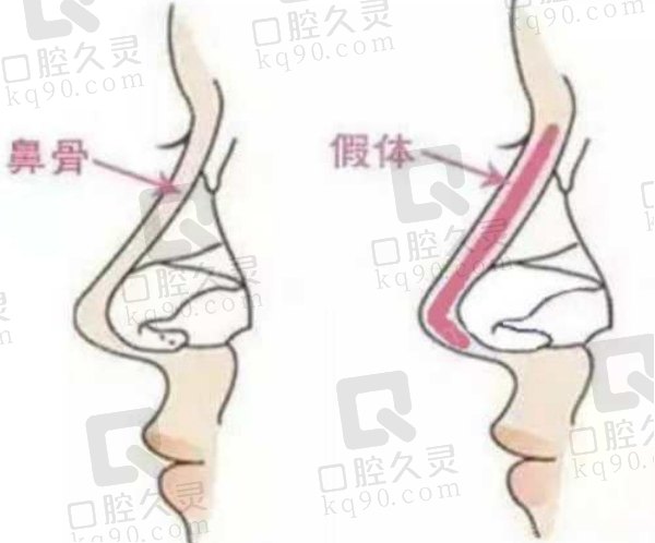 深圳宝丽李信锋做鼻子怎么样