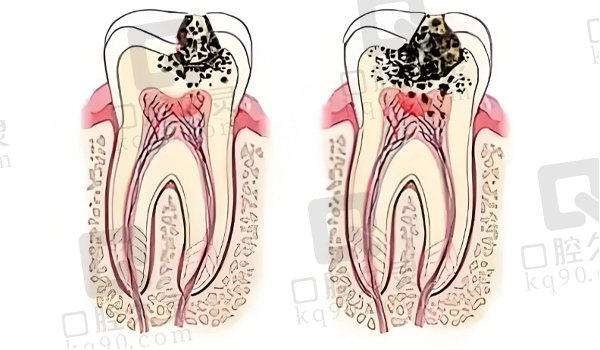 没做根管可能会感染恶化