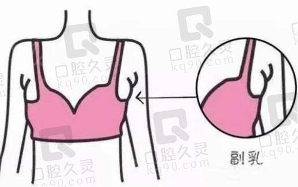 副乳吸脂后有硬块是什么情况