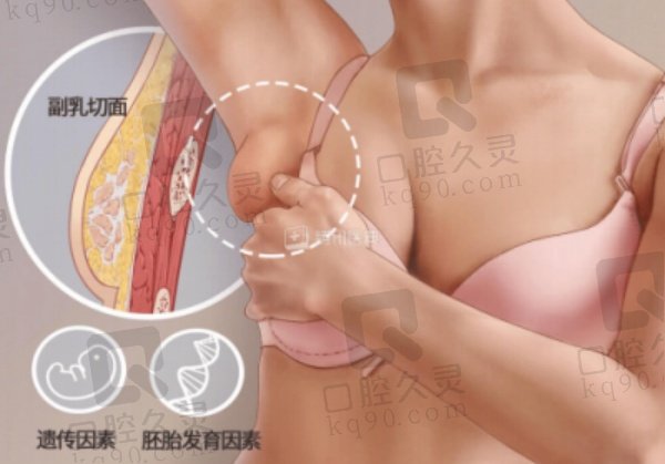 副乳吸脂需要穿塑身衣吗