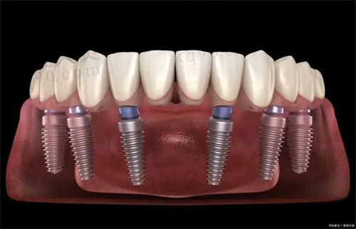 杭州富阳口腔医院种植牙有哪些优势
