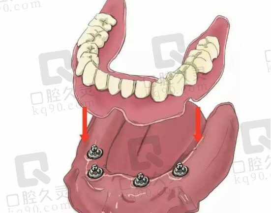 浙中金义口腔医院韩国半口种植牙套餐明细表