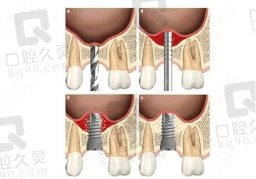 种植牙外提升是什么意思?