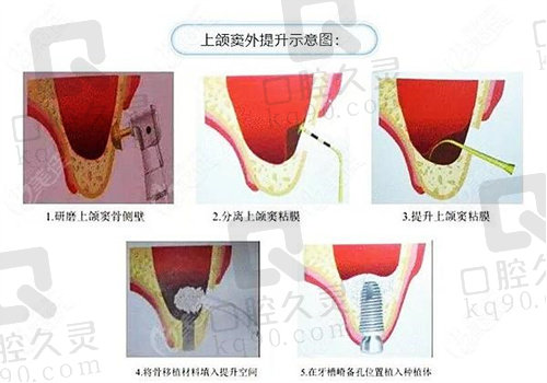 种植牙外提升的注意事项有哪些?