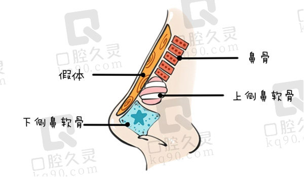 膨体隆鼻生物相容性好