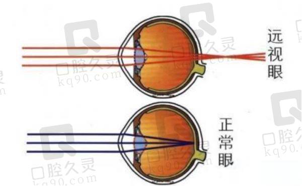 眼睛屈光不正的日常护理与眼部健康