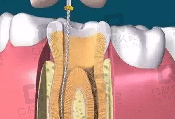 后牙根管治疗要几次