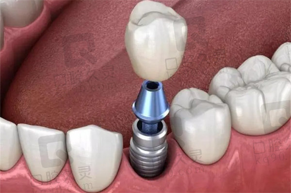 新乡植得口腔种植牙医生介绍