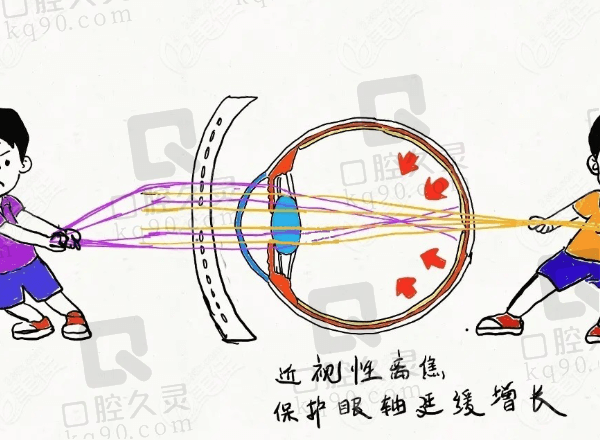 小孩近视ok镜和防控眼镜疗效对比