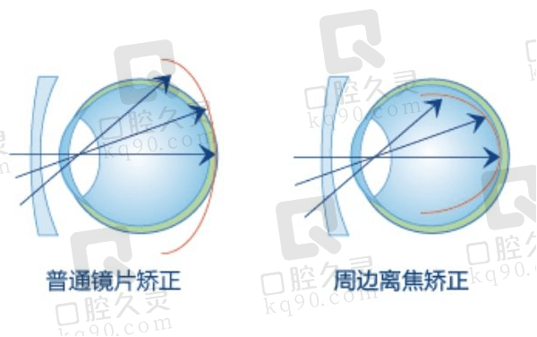 小孩近视ok镜和防控眼镜年龄适用性对比