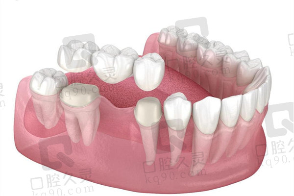 种植牙和搭桥牙利弊