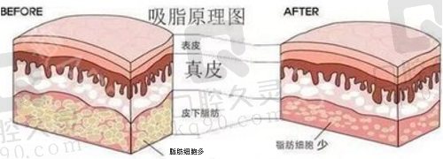 北京丽都高海燕吸脂怎么样？