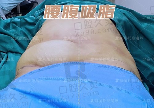 北京丽都高海燕医生腰腹吸脂术后即刻对比