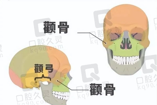 颧骨外扩和颧骨高的区别