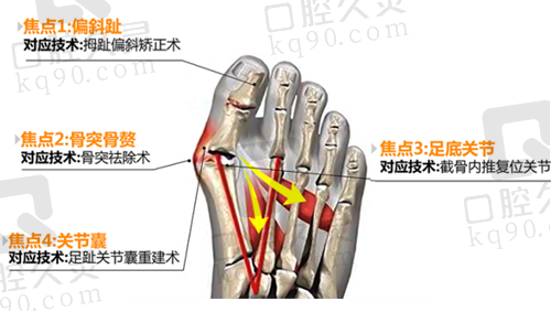 北京圣嘉新陈圣英医生做大脚骨手术怎么样？