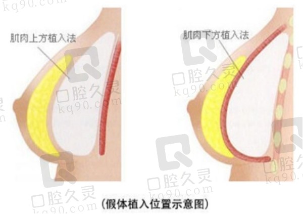 深圳富华医疗美容医院隆胸怎么样