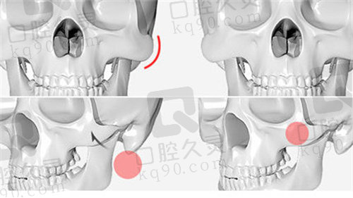 四川友谊罗恩医生3D颧骨缩小术优势