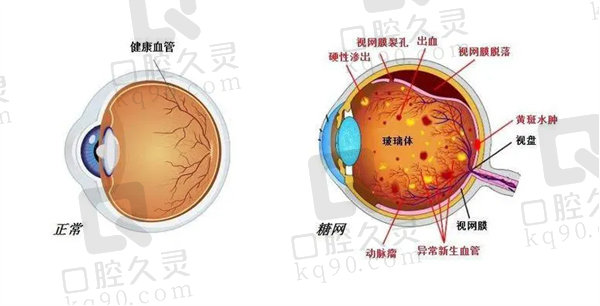 深圳爱尔眼科医院视网膜手术