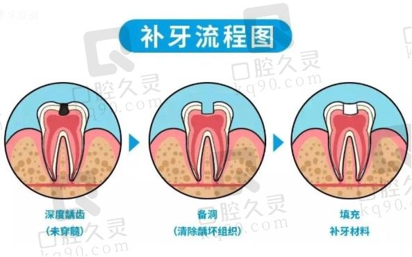 北京牙元素口腔补牙怎么收费