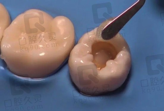 北京牙元素口腔补牙价格贵吗？