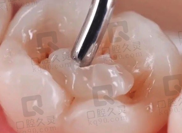 Z250树脂补牙的优势