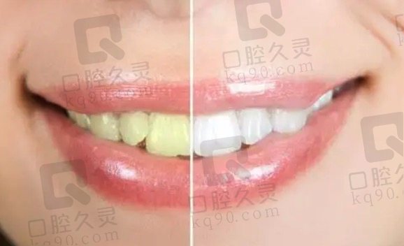 北京牙元素口腔做美国冷光牙齿美白的优势
