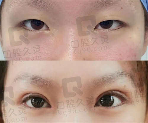 完成双眼皮项目后的变化及复查情况