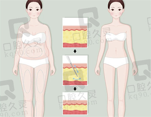 四川友谊李发展医生BodyTite+脂肪3D光雕术优势