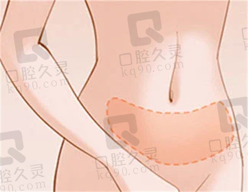 成都李发展抽脂怎么样？