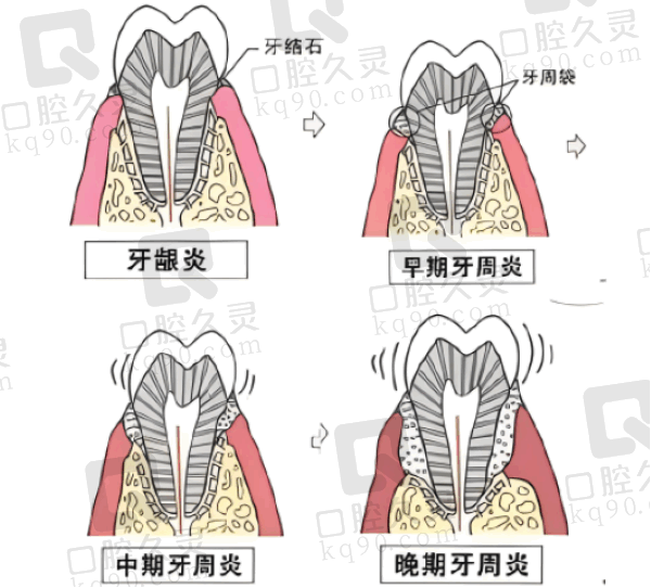 固定松动牙齿价格