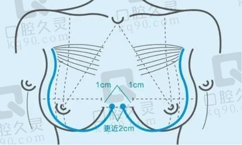 北京米兰柏羽丽都大容量假体丰胸术