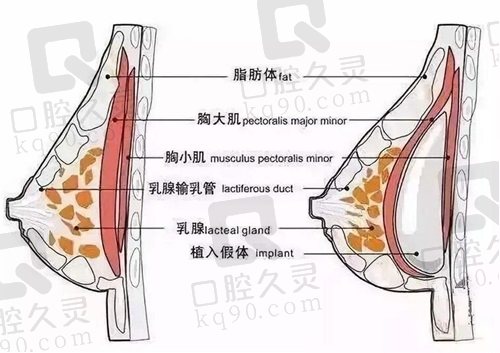 北京米兰柏羽丽都大容量假体丰胸术