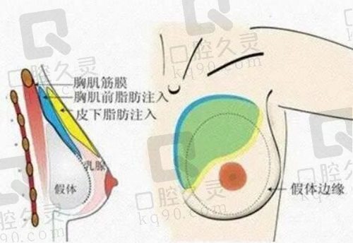 北京米兰柏羽丽都大容量假体丰胸术