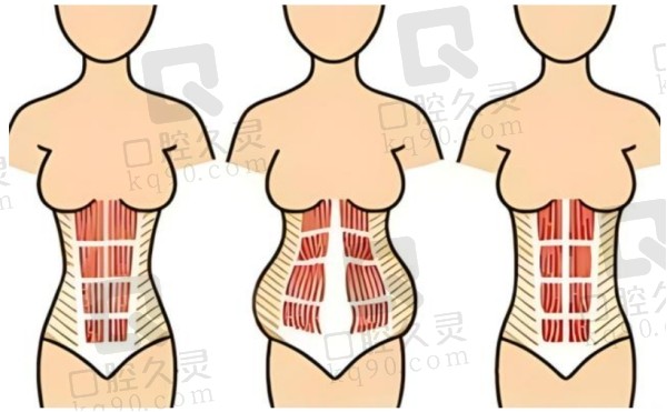 杭州整形医院腹壁成形术怎么样