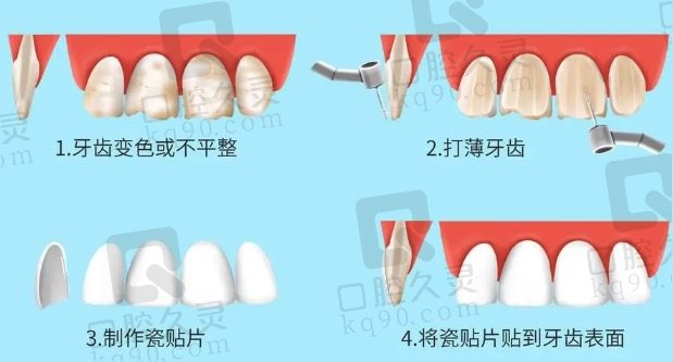 登士柏灵犀瓷贴面的适用人群